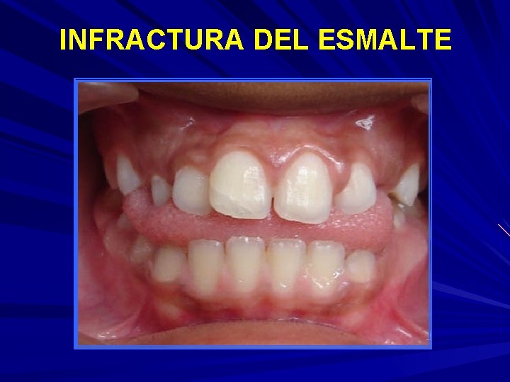 INFRACTURA DEL ESMALTE 