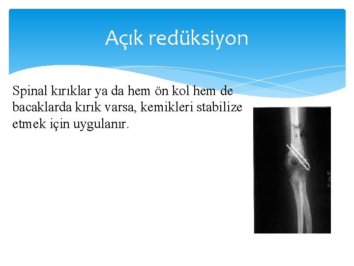 Açık redüksiyon Spinal kırıklar ya da hem ön kol hem de bacaklarda kırık varsa,