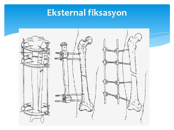 Eksternal fiksasyon 