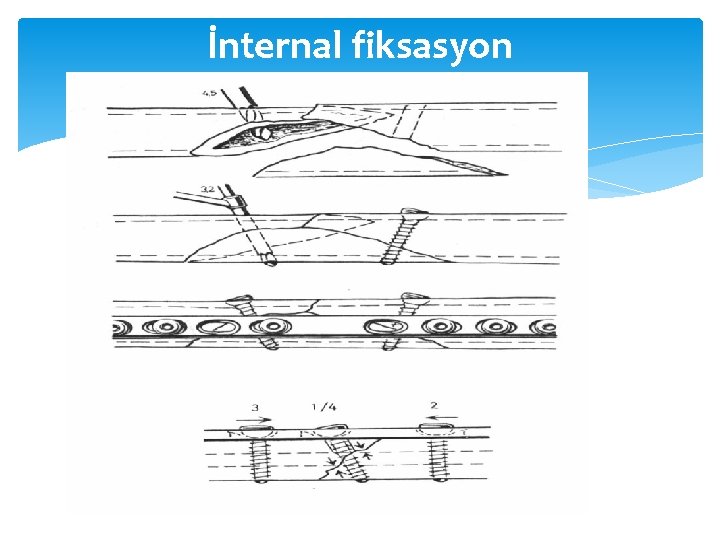 İnternal fiksasyon 