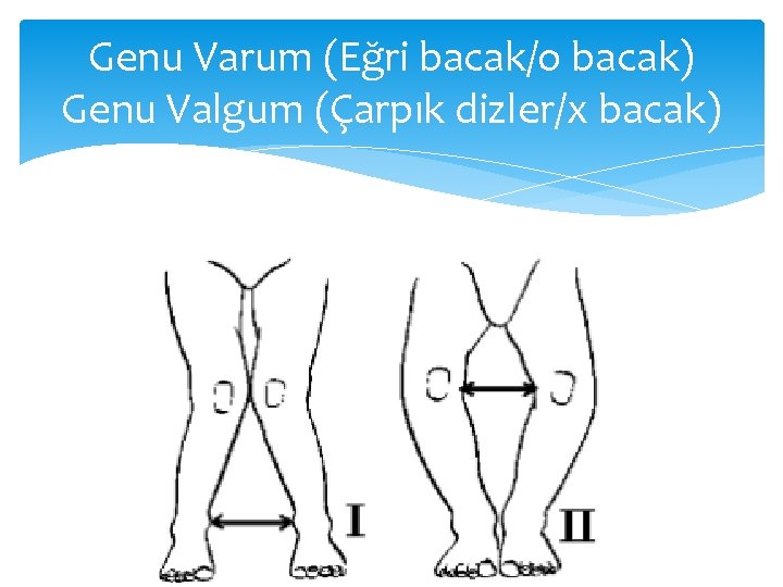 Genu Varum (Eğri bacak/o bacak) Genu Valgum (Çarpık dizler/x bacak) 