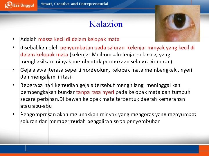 Kalazion • Adalah massa kecil di dalam kelopak mata • disebabkan oleh penyumbatan pada Kalazion • Adalah massa kecil di dalam kelopak mata • disebabkan oleh penyumbatan pada