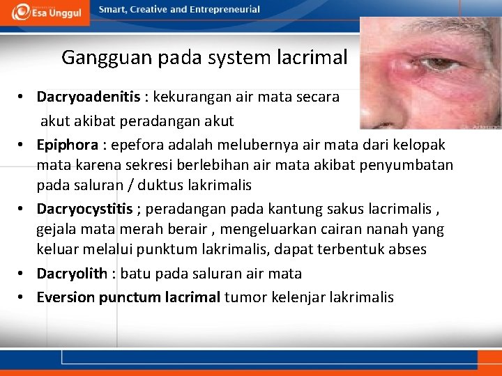 Gangguan pada system lacrimal • Dacryoadenitis : kekurangan air mata secara akut akibat peradangan Gangguan pada system lacrimal • Dacryoadenitis : kekurangan air mata secara akut akibat peradangan