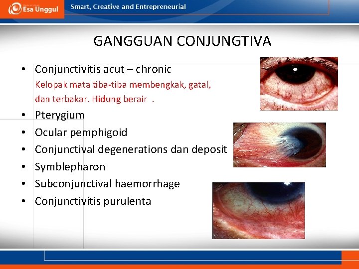 GANGGUAN CONJUNGTIVA • Conjunctivitis acut – chronic Kelopak mata tiba-tiba membengkak, gatal, dan terbakar. GANGGUAN CONJUNGTIVA • Conjunctivitis acut – chronic Kelopak mata tiba-tiba membengkak, gatal, dan terbakar.