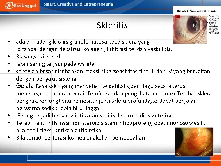 Skleritis • adalah radang kronis granulomatosa pada sklera yang ditandai dengan dekstrusi kolagen , Skleritis • adalah radang kronis granulomatosa pada sklera yang ditandai dengan dekstrusi kolagen ,