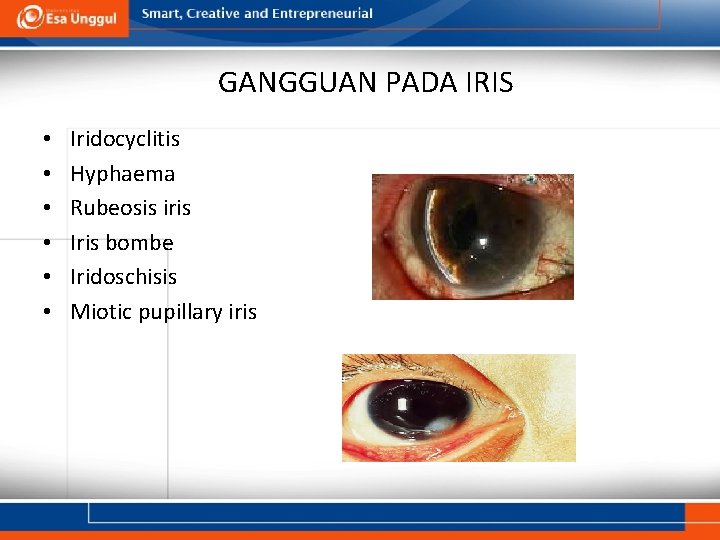 GANGGUAN PADA IRIS • • • Iridocyclitis Hyphaema Rubeosis iris Iris bombe Iridoschisis Miotic GANGGUAN PADA IRIS • • • Iridocyclitis Hyphaema Rubeosis iris Iris bombe Iridoschisis Miotic