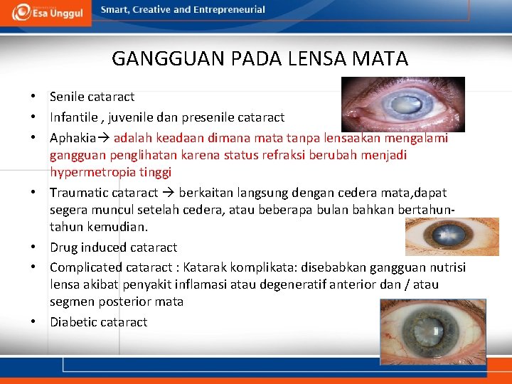 GANGGUAN PADA LENSA MATA • Senile cataract • Infantile , juvenile dan presenile cataract GANGGUAN PADA LENSA MATA • Senile cataract • Infantile , juvenile dan presenile cataract