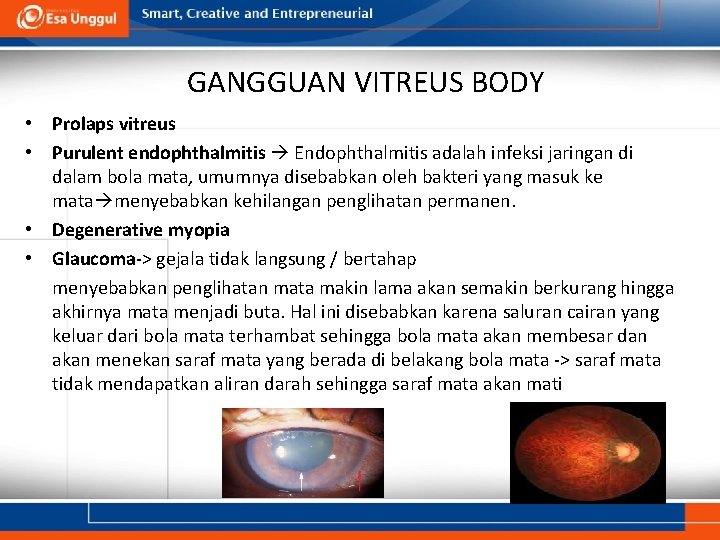 GANGGUAN VITREUS BODY • Prolaps vitreus • Purulent endophthalmitis Endophthalmitis adalah infeksi jaringan di GANGGUAN VITREUS BODY • Prolaps vitreus • Purulent endophthalmitis Endophthalmitis adalah infeksi jaringan di