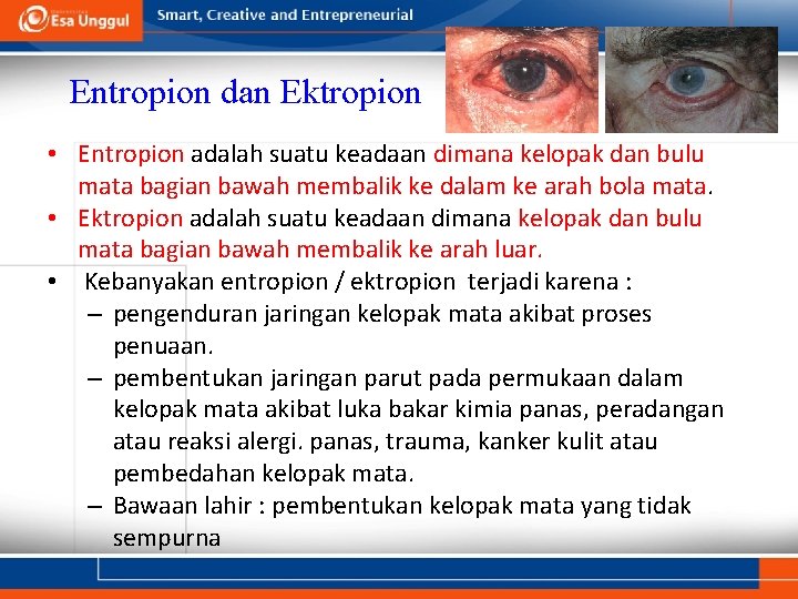 Entropion dan Ektropion • Entropion adalah suatu keadaan dimana kelopak dan bulu mata bagian Entropion dan Ektropion • Entropion adalah suatu keadaan dimana kelopak dan bulu mata bagian