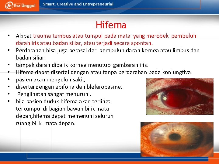 Hifema • Akibat trauma tembus atau tumpul pada mata yang merobek pembuluh darah iris Hifema • Akibat trauma tembus atau tumpul pada mata yang merobek pembuluh darah iris
