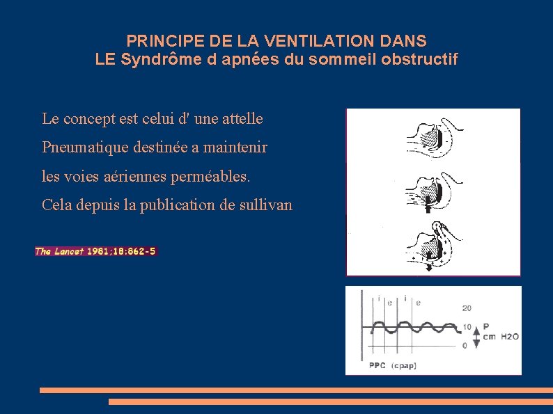 PRINCIPE DE LA VENTILATION DANS LE Syndrôme d apnées du sommeil obstructif Le concept