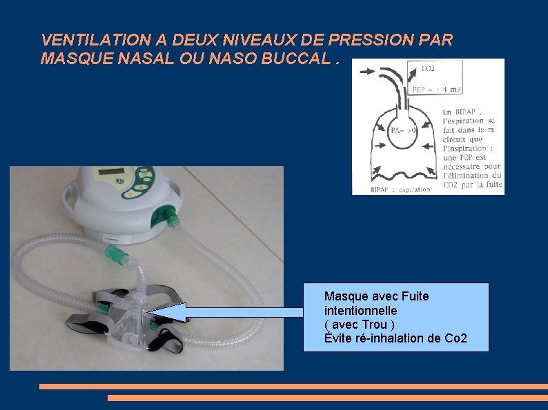 VENTILATION A DEUX NIVEAUX DE PRESSION PAR MASQUE NASAL OU NASO BUCCAL. Masque avec