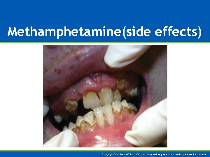 Methamphetamine(side effects) Copyright Goodheart-Willcox Co. , Inc. May not be posted to a publicly
