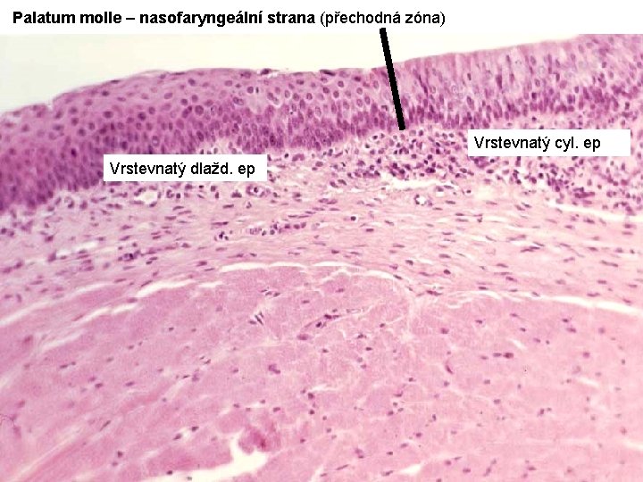 Palatum molle – nasofaryngeální strana (přechodná zóna) Vrstevnatý cyl. ep Vrstevnatý dlažd. ep 