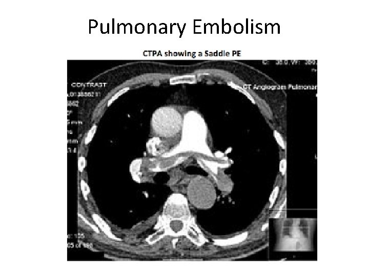 Pulmonary Embolism 