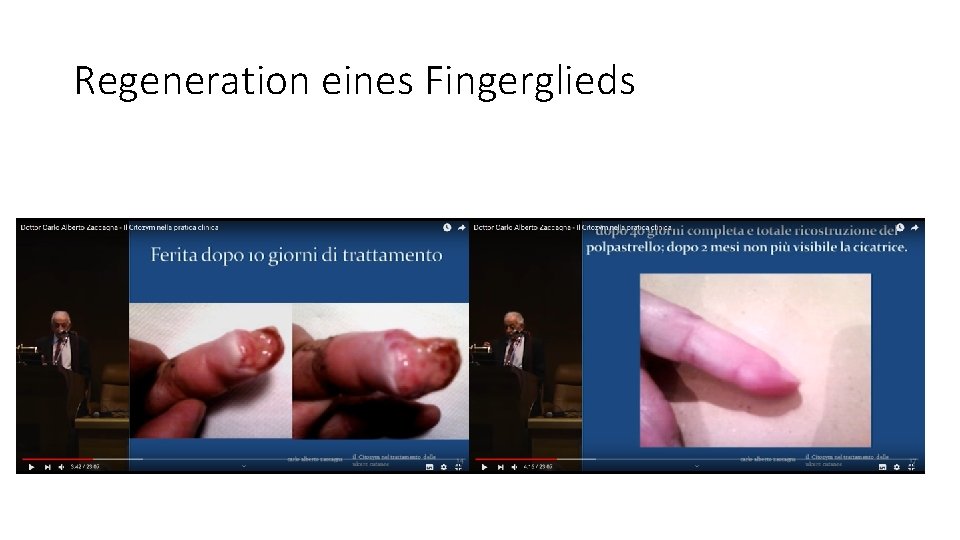 Regeneration eines Fingerglieds 