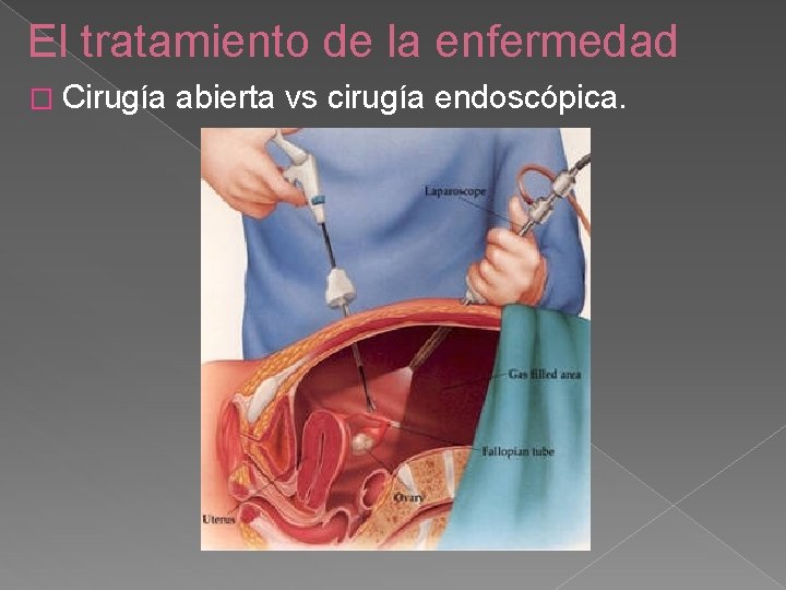 El tratamiento de la enfermedad � Cirugía abierta vs cirugía endoscópica. 