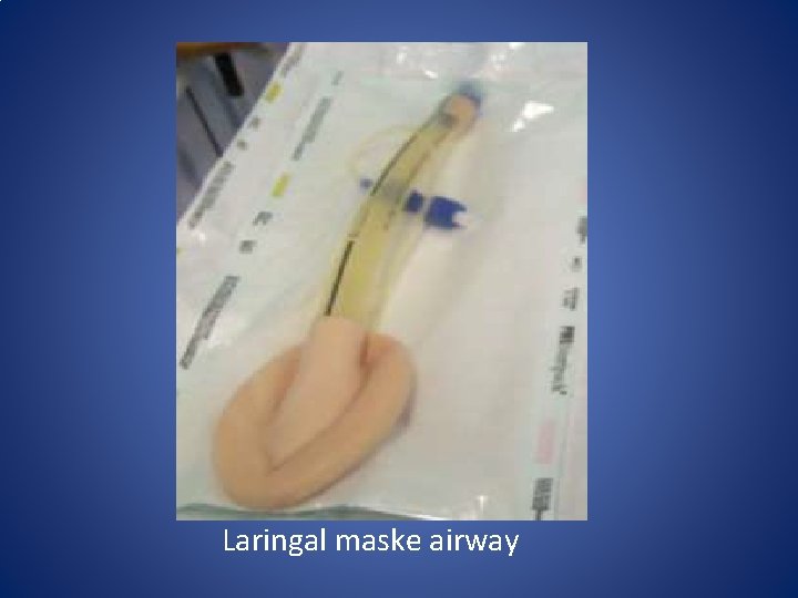 Laringal maske airway Laringal maske airway