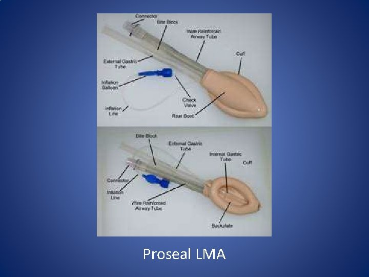 Proseal LMA Proseal LMA