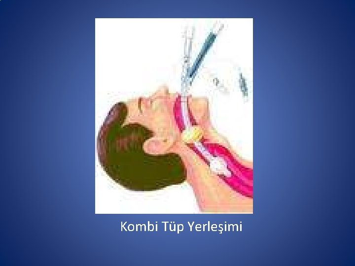 Kombi Tüp Yerleşimi Kombi Tüp Yerleşimi