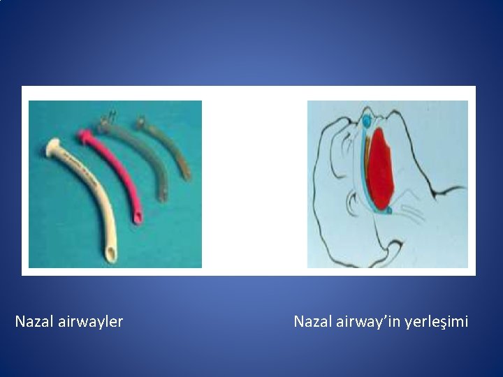 Nazal airwayler Nazal airway’in yerleşimi Nazal airwayler Nazal airway’in yerleşimi