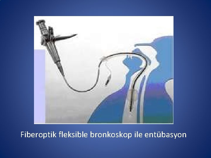 Fiberoptik fleksible bronkoskop ile entübasyon Fiberoptik fleksible bronkoskop ile entübasyon