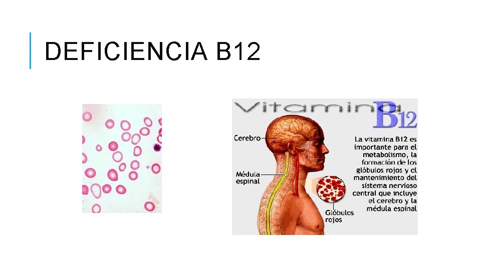 DEFICIENCIA B 12 