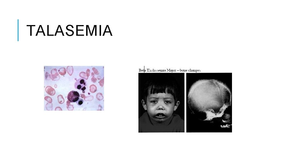 TALASEMIA 