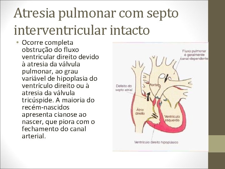 Atresia pulmonar com septo interventricular intacto • Ocorre completa obstrução do fluxo ventricular direito