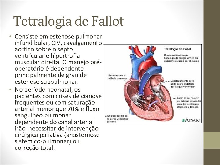 Tetralogia de Fallot • Consiste em estenose pulmonar infundibular, CIV, cavalgamento aórtico sobre o