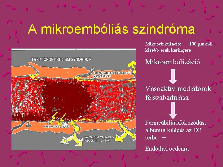 A mikroembóliás szindróma Mikrocirkuláció: 100 mm-nél kisebb erek keringése Mikroembolizáció Vasoaktív mediátorok felszabadulása Permeábilitásfokozódás,
