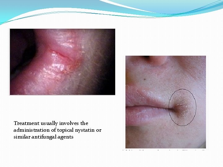 Treatment usually involves the administration of topical nystatin or similar antifungal agents 