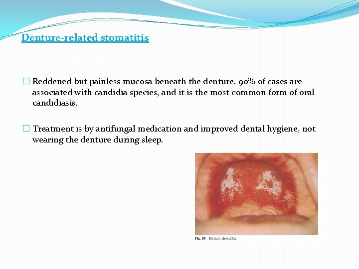 Denture-related stomatitis � Reddened but painless mucosa beneath the denture. 90% of cases are