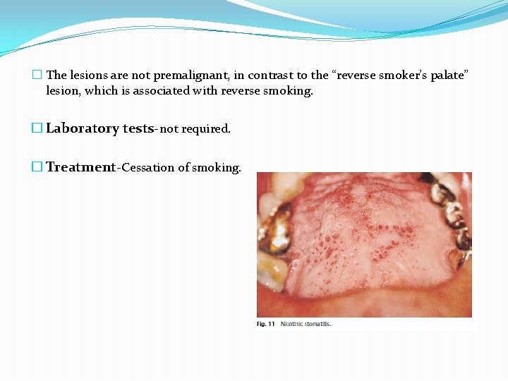 � The lesions are not premalignant, in contrast to the “reverse smoker’s palate” lesion,