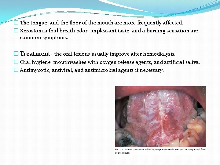 � The tongue, and the floor of the mouth are more frequently affected. �