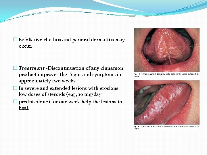 � Exfoliative cheilitis and perioral dermatitis may occur. � Treatment -Discontinuation of any cinnamon