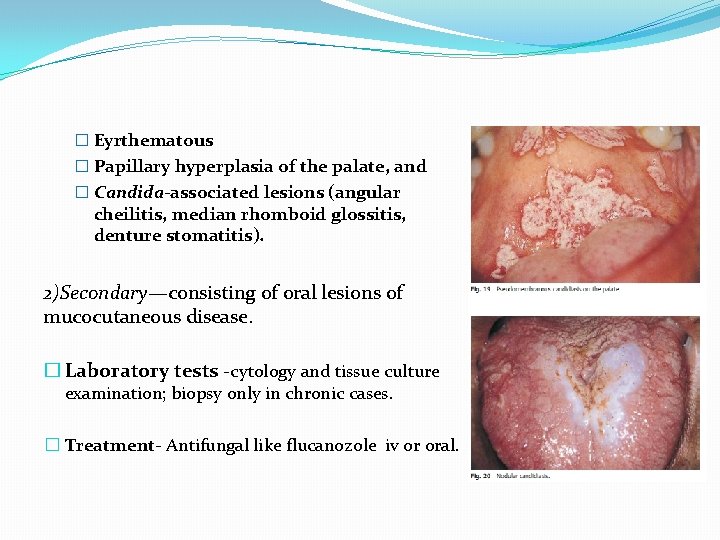 � Eyrthematous � Papillary hyperplasia of the palate, and � Candida-associated lesions (angular cheilitis,