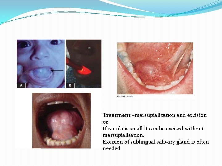 Treatment –marsupialization and excision or If ranula is small it can be excised without