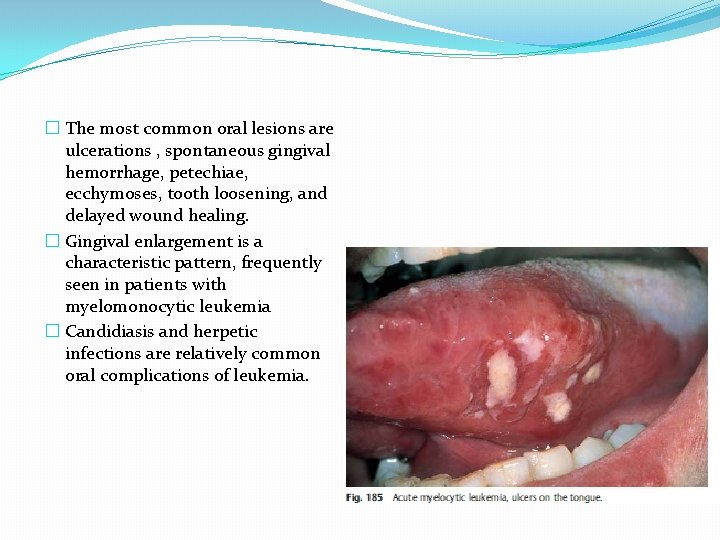 � The most common oral lesions are ulcerations , spontaneous gingival hemorrhage, petechiae, ecchymoses,