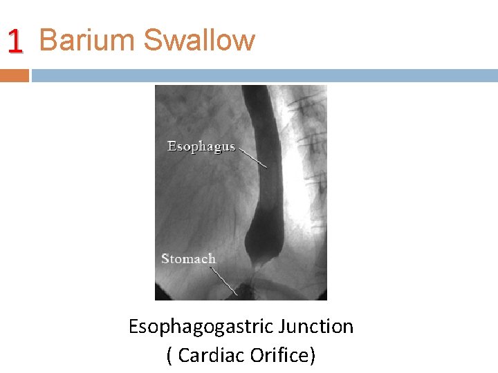 1 Barium Swallow Esophagogastric Junction ( Cardiac Orifice) 