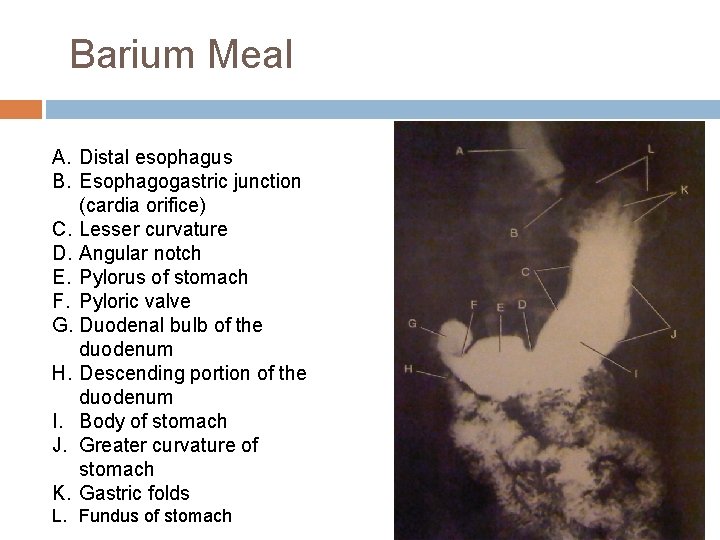 Barium Meal A. Distal esophagus B. Esophagogastric junction (cardia orifice) C. Lesser curvature D.