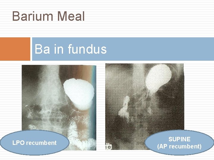 Barium Meal Ba in fundus 2 LPO recumbent SUPINE (AP recumbent) 