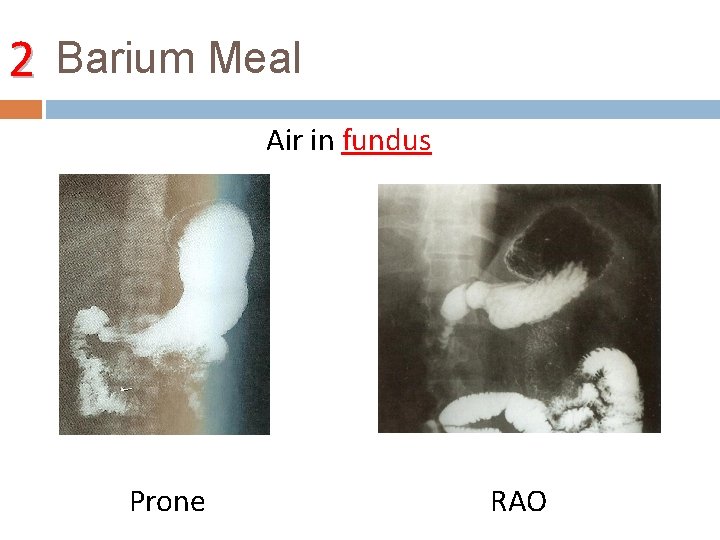 2 Barium Meal Air in fundus Prone RAO 
