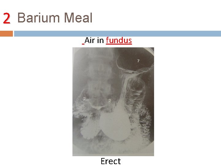 2 Barium Meal Air in fundus Erect 