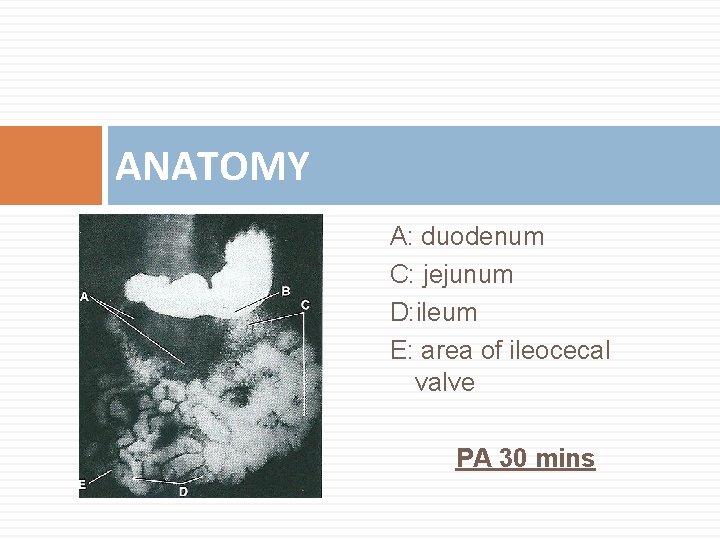 ANATOMY A: duodenum C: jejunum D: ileum E: area of ileocecal valve PA 30