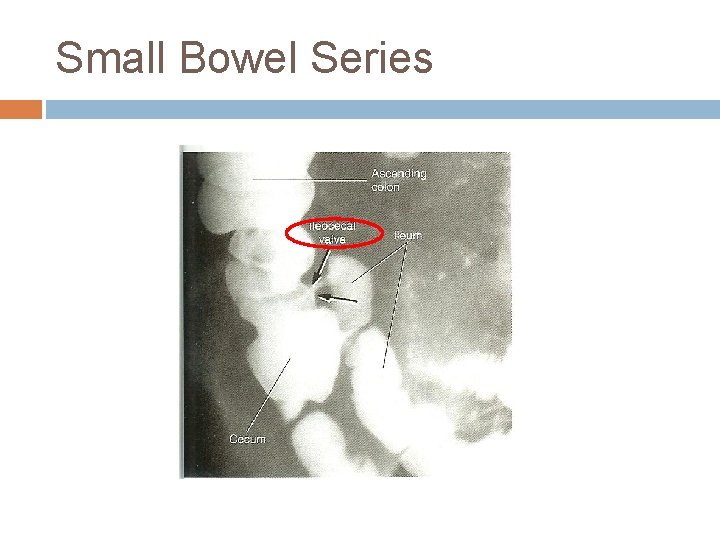 Small Bowel Series 