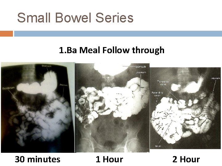 Small Bowel Series 1. Ba Meal Follow through 30 minutes 1 Hour 2 Hour