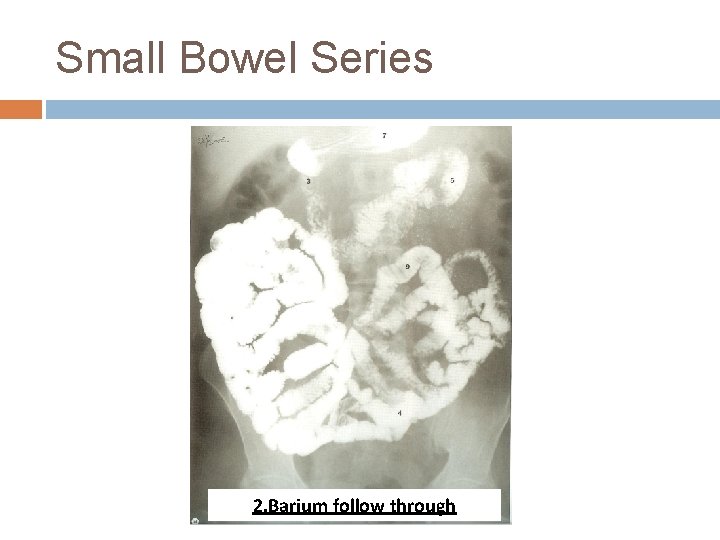 Small Bowel Series 2. Barium follow through 