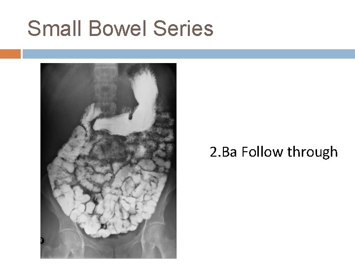 Small Bowel Series 2. Ba Follow through 