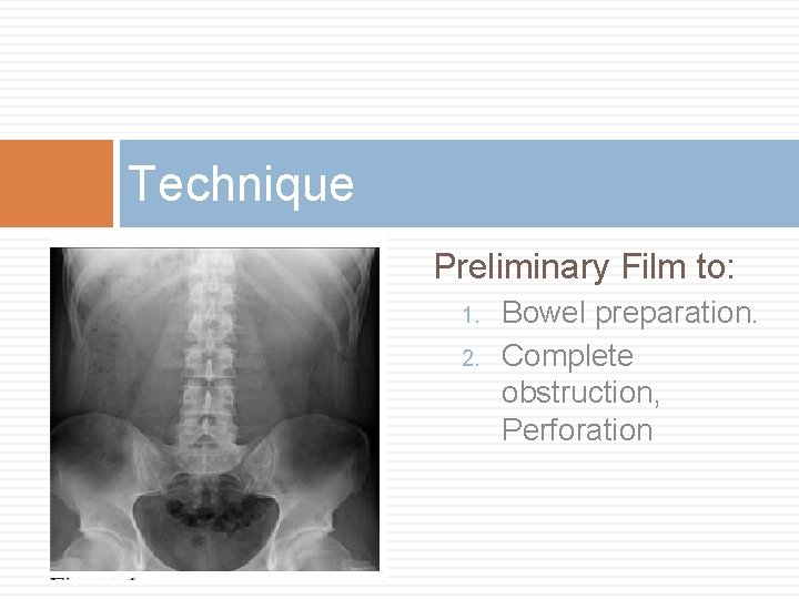 Technique Preliminary Film to: 1. 2. Bowel preparation. Complete obstruction, Perforation 